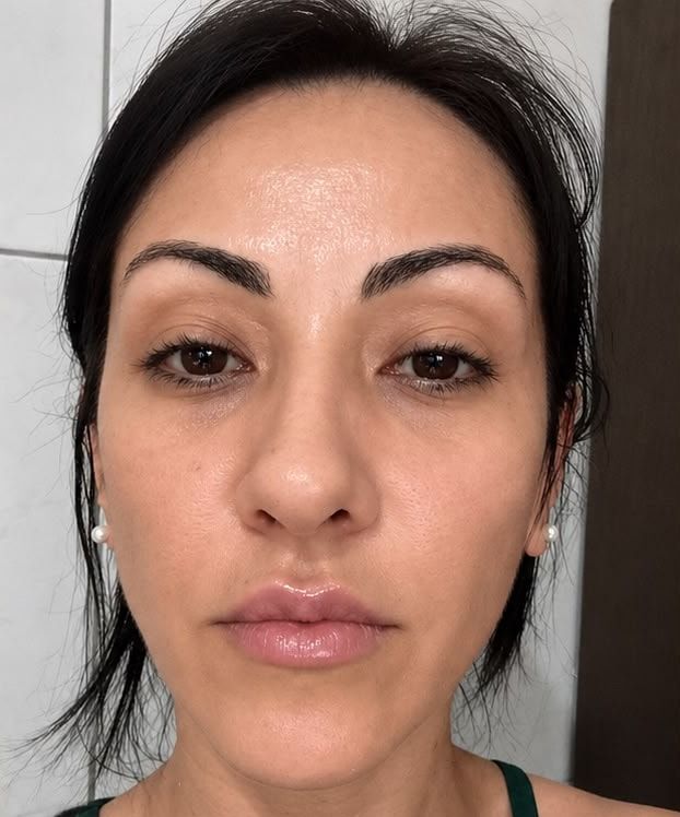 Depois: rosto da mesma paciente, de frente, de blusa verde.