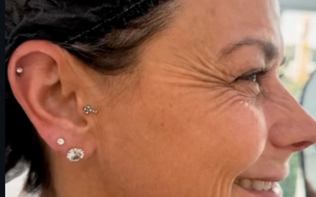 Antes: perfil de uma paciente sorrindo, com rugas no canto do olho.