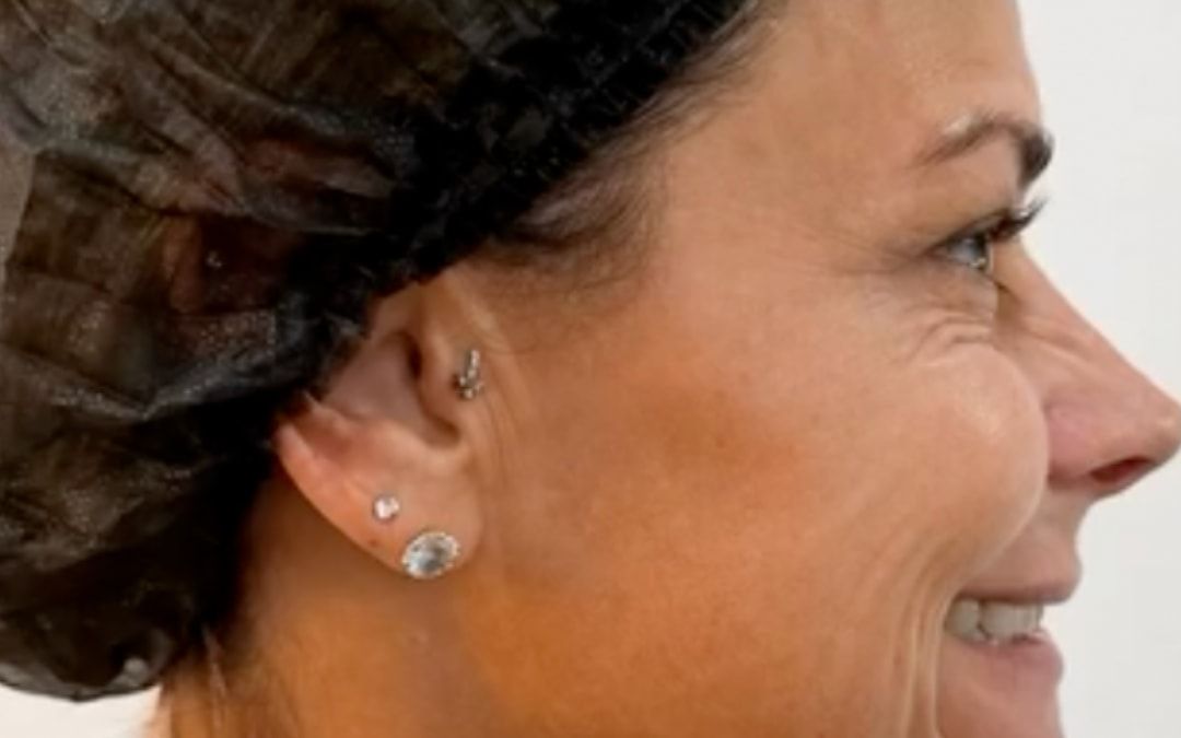 Depois: perfil da mesma paciente sorrindo.