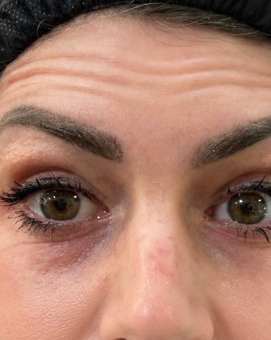 Antes: testa e olhos de uma paciente, com rugas na testa.